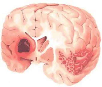 Ahogy kezelt terjeszkedés convexital subarachnoidealis térben (mellék subarachnoidalis convexital) Mivel a bővítő kezelt subarachnoidális térben convexital