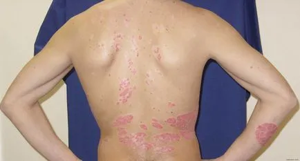 Mivel lehet gyógyítani gyorsan megszabadulni a psoriasis