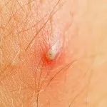 Hogyan könnyítsen szőr a lábát, és hogyan elszíneződések hidrogén-peroxiddal