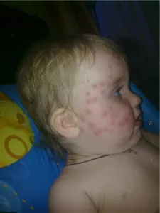 Megkülönböztetve szúnyogcsípés bug harapás (harapás szúnyog bogarak) Hogyan lehet megkülönböztetni egy szúnyogcsípés által harapás bug