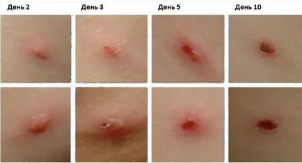 Hogy van bárányhimlő, megelőzés, a betegség tüneteit (attól függően, hogy az immunrendszer állam) Hogy van a bárányhimlő, a megelőzés, a tünetek