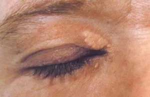 Hogyan lehet eltávolítani a zsíros tumor szeme alatt otthon (szem) Hogyan lehet eltávolítani a zsíros tumor szeme alatt otthon