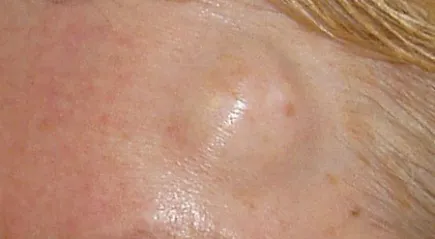 Wen squeeze elszállítani vagy kezelni (wen) Hogyan lehet eltávolítani a zsíros tumor squeeze vagy kezelésére