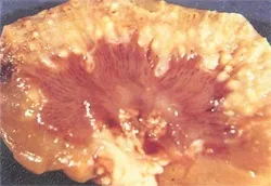 Krónikus pyelonephritis emberek jogorvoslatok Krónikus pyelonephritis emberek jogorvoslatok