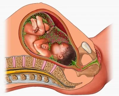 Chlamydia és a terhesség kezelés Chlamydia és a terhesség kezelés