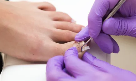Benőtt köröm, mint a gyógyítás Benőtt köröm, mint a gyógyítás