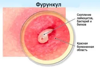 Hogyan lehet gyógyítani a forraljuk otthon - a leghatékonyabb receptek (gyógyítás) Hogyan lehet gyógyítani a forraljuk otthon - a leghatékonyabb receptek