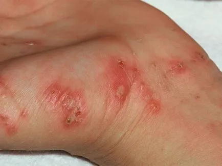 Hogyan működik egy emberi rüh tünetek, rüh kezelésére emberekben, gyermek népi