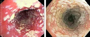 A nyelőcső-candidiasis okok, tünetek, kezelés, fotók