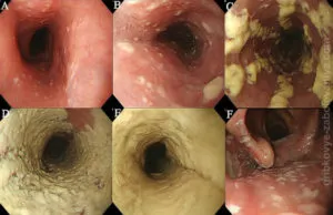 A nyelőcső-candidiasis okok, tünetek, kezelés, fotók
