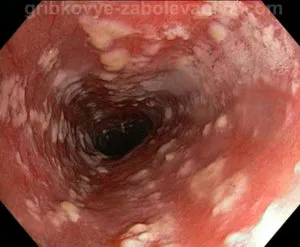 A nyelőcső-candidiasis okok, tünetek, kezelés, fotók