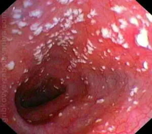 A nyelőcső-candidiasis okok, tünetek, kezelés, fotók