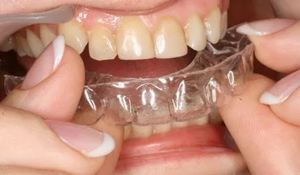 Capa után zárójelek - rögzítjük az eredményt a kezelés malocclusion