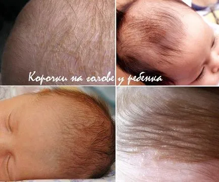 Barna színű csecsemők - az okok, hogyan lehet eltávolítani őket (barna a fej csecsemőkben) Barna színű csecsemők - az okok, hogyan lehet eltávolítani őket