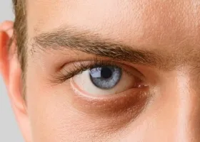 exophthalmus kezelés