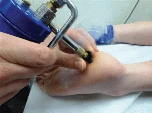 Szemölcsök kezelésére a lábát, és a választott módszer (szemölcsök) Szemölcsök kezelésére a lábát, és a választott módszer