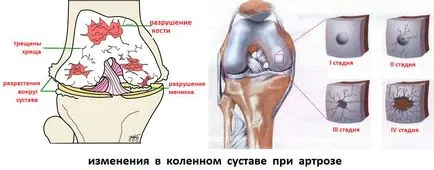 Kezelése gonarthrosis népi jogorvoslat
