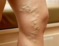 Kezelése thrombophlebitis az alsó végtagok az otthoni, valamint, mint kezelni mély thrombophlebitis