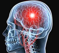 Agyvérzés kezelésére, a stroke tüneteinek és kóma, ha az étrend - az orvosi enciklopédia (stroke) Agyvérzés kezelésére, a stroke tüneteinek és kóma, ha az étrend - az orvosi enciklopédia