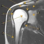 MRI a vállízület, mint csinál, hogy lehet kimutatni