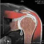 MRI a vállízület, mint csinál, hogy lehet kimutatni
