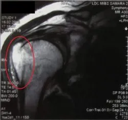 MRI a vállízület, hogy ki lehet mutatni, mint ahogy a diagnózis (do) MRI a vállízület, hogy ki lehet mutatni, mint ahogy a diagnosztika
