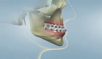 Overbite (az alsó állkapocs mozgatása előre) rögzíti segítségével ortopédiai rendszerek és