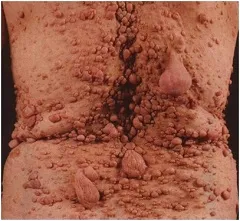 Neurofibromatózis - okai, típusai, tünetei, a kezelés, megelőzés