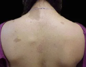Neurofibromatózis Recklinghausen fotó, típusai, okai és tünetei, diagnózisa és kezelése a betegség