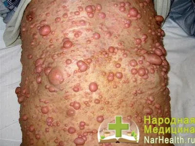 Neurofibromatózis - tünetek, okok, kezelés neurofibromatózis, fotók és videó (neurofibromatózis) Neurofibromatózis - tünetek, okok, kezelés neurofibromatózis, fotó és videó