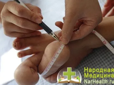 Neurofibromatózis - tünetek, okok, kezelés neurofibromatózis, fotók és videó (neurofibromatózis) Neurofibromatózis - tünetek, okok, kezelés neurofibromatózis, fotó és videó