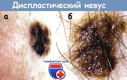 diszpláziás nevus