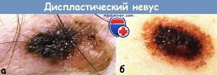 diszpláziás nevus