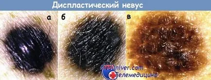 diszpláziás nevus