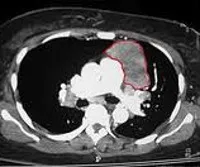 Mediastinalis tumor - okai, tünetei, diagnózis és kezelés (tumor) Mediastinalis tumor - okai, tünetei, diagnózisa és kezelése