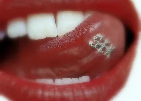 Piercing transzdermális implantátum helyének kiválasztása, oktatás, ellátás