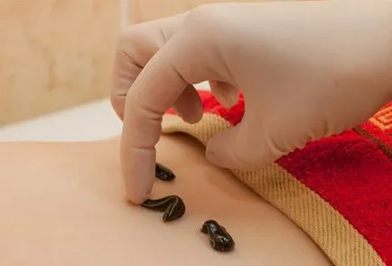 Piócák endometriózis kezelésében együtt, amely Nőgyógyászati