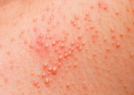 Elsősegély allergia - otthon, a sürgősségi, akut reakciók, a gyermek, az (első) Elsősegély allergia - otthon, a sürgősségi, akut reakciók a gyermek