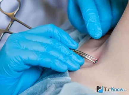 Piercing transzdermális implantátum helyének kiválasztása, oktatás, ellátás