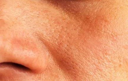 Miért eltömítik a pórusokat az arcodon