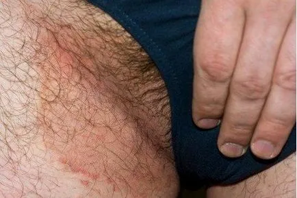Bőrpír az ágyék férfiaknál, mint a gyógyítás, az okok és a tünetek (férfi) Bőrpír az ágyék férfiaknál, mint a gyógyítás, az okok és tünetek