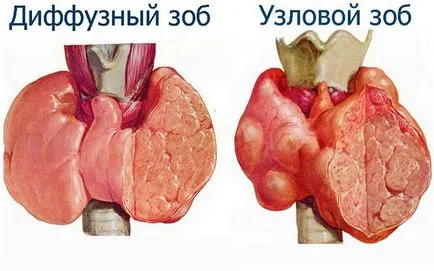 Tünetei golyva, struma nők körében