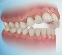 Az arányok az arc és malocclusion