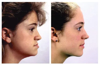 Az arányok az arc és malocclusion