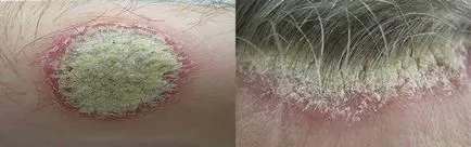 Psoriasis okai és kezelése