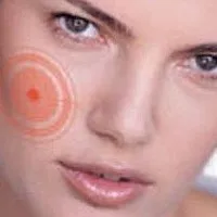 Izgató az arcon okoz, kezelések és a hagyományos receptek (irritáció) Izgató az arcon okoz, kezelések és a hagyományos receptek