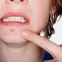 Izgató az arcon okoz, kezelések és a hagyományos receptek (módszerek) Izgató az arcon okoz, kezelések és a hagyományos receptek