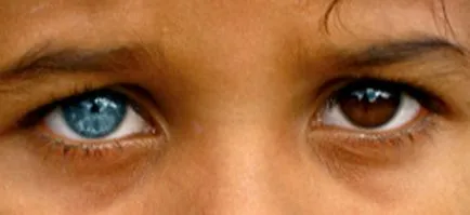 Különböző szemszín minden tudás heterochromia (különböző) Különböző szemszín minden tudás heterochromia