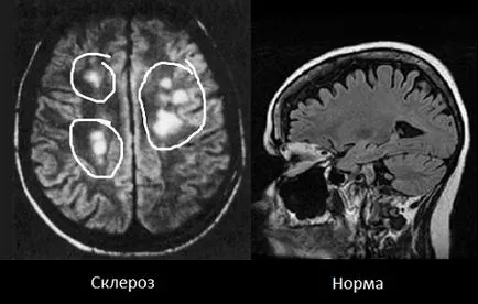 A sclerosis multiplex tünetei, kezelés, a tünetek, okok