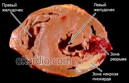 Törés a szív okozza, típusai, tünetei és kezelése, a prognózis az élet
